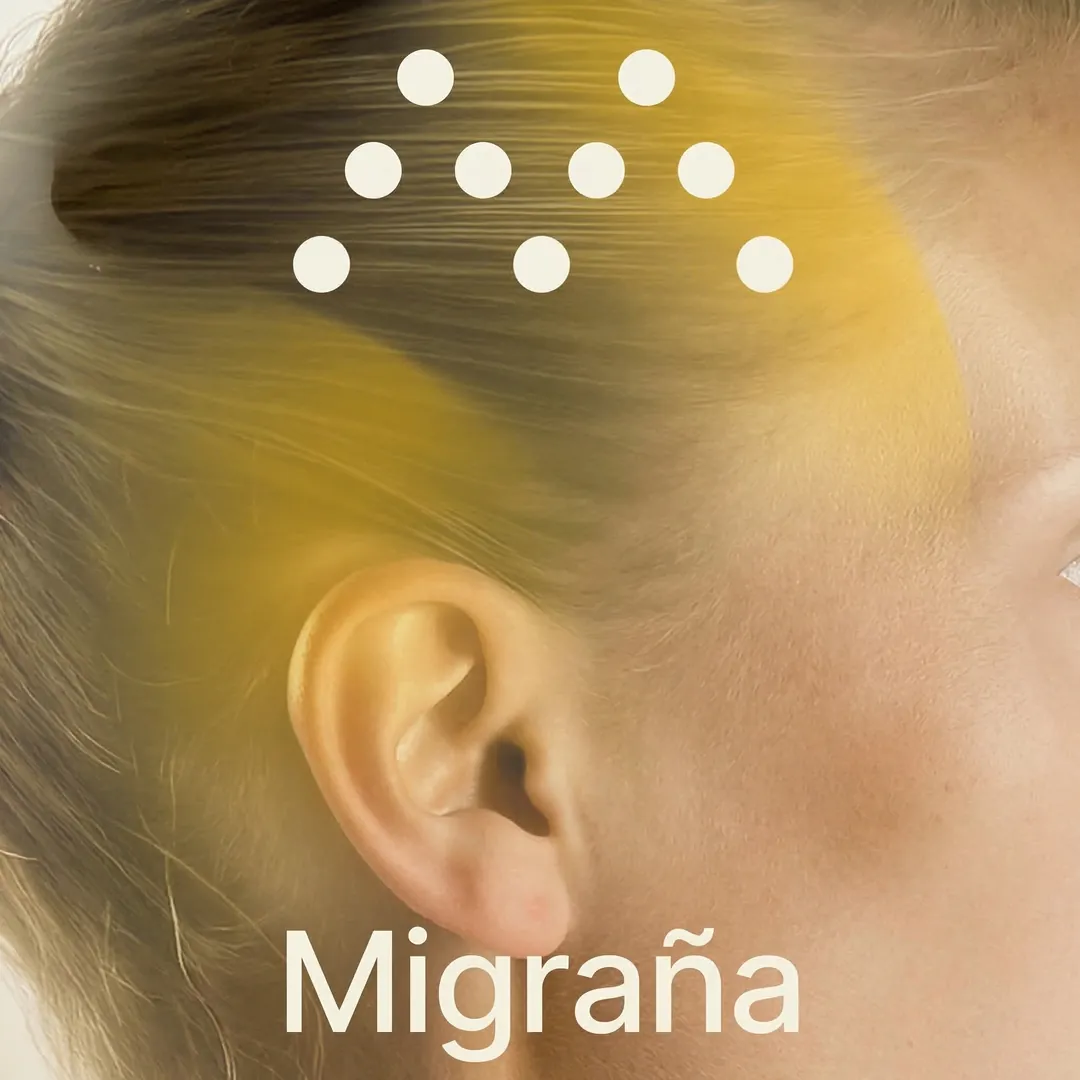 Tratamiento de Migraña con toxina botulínica